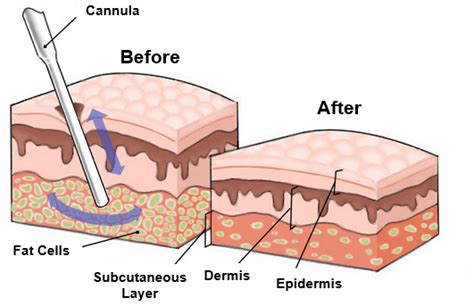 Traditional Liposuction vs Smart Lipo vs I-Lipo ⋆ Anna Esthetics, Tampa, Oldsmar