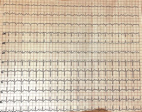 Atrial Tachycardia Masquerading As Inappropriate Sinus Tachycardia (IST) After COVID-19 ...