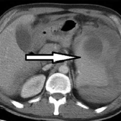 Ruptured spleen (white arrow). | Download Scientific Diagram