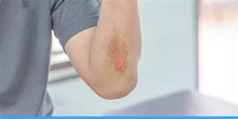 What Are The Difference Between Abrasion VS. Laceration?