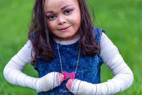 Epidermolysis bullosa: meet the woman who lives in bandages – Archyde