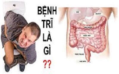 Bệnh trĩ là gì? Bệnh trĩ có nguy hiểm không | Sức khỏe, Cỏ