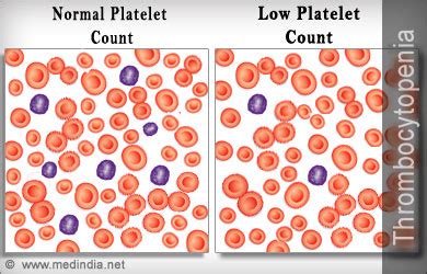 Platelet Count; Blood Platelet Count; Blood Platelet Number; Platelet ...