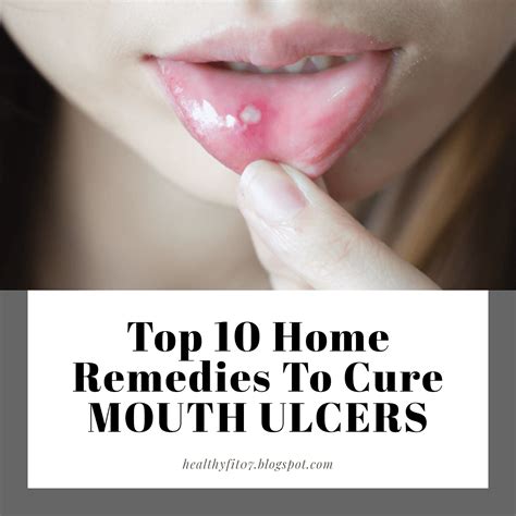 How Can I Treat Mouth Ulcers - Printable Templates