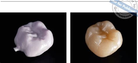 E.-max CAD crown after preparation and after crystallization firing.... | Download Scientific ...