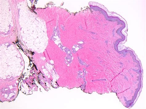 Eosinophilic Fasciitis (Shulman Disease, Diffuse Fasciitis with Eosinophilia) - Dermatology Advisor