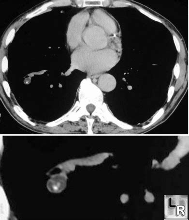 LearningRadiology - Hamartoma of Lung