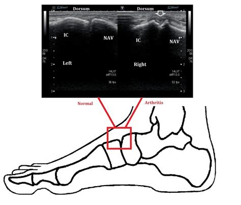 Midfoot Arthritis - Ankle, Foot and Orthotic Centre