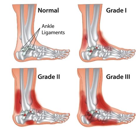 Sprained Ankle (Ankle Sprain) Info and Treatment | SportNova UK