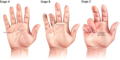 Dupuytren's Contracture Explained - TherAuthority