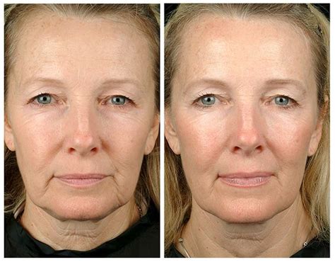 Ultherapy vs Thermage: Your Guide on Picking the Right Treatment