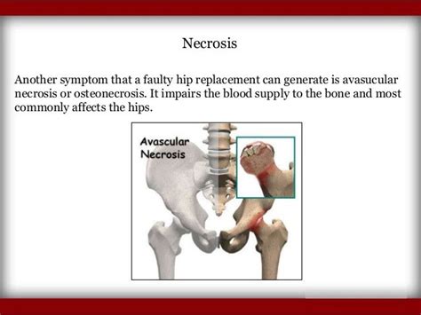 Symptoms of Hip Replacement Implant Recall