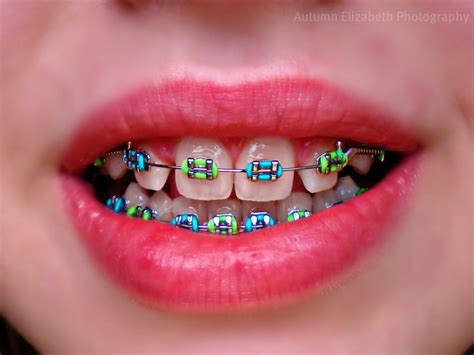 Brace Race: Week 5 - Teal and Lime | Getting braces, Teeth braces, Green braces