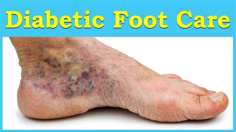 Diabetic Foot Problems: Symptoms, Treatment, and Care | ABC Health - YouTube