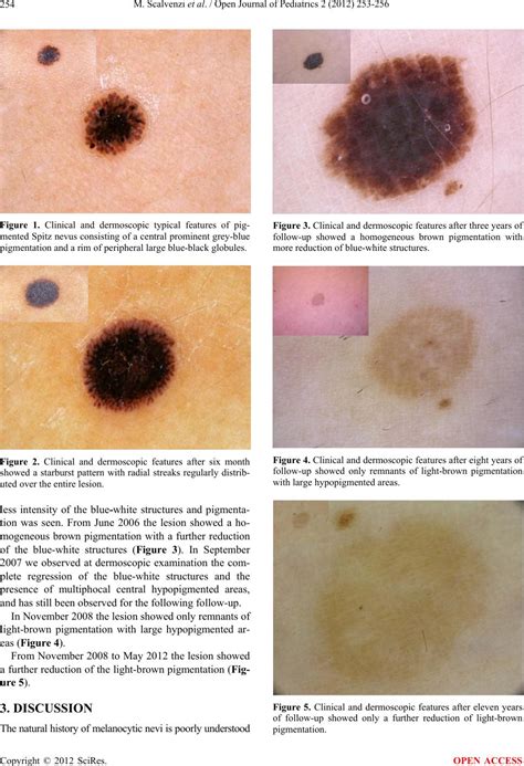 Long term clinical and dermoscopic follow-up of a child with a Spitz nevus