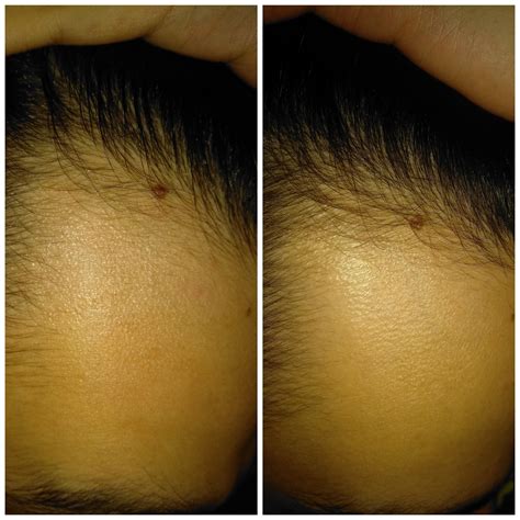 Finasteride 2 months/ 4 months 10 days : r/tressless