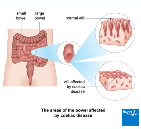 Celiac disease - KelliAllanah