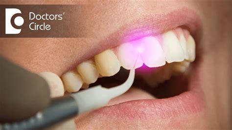 The Laser Gum Treatment Guide – Braces Explained