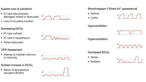 End-Tidal Waveform Capnography