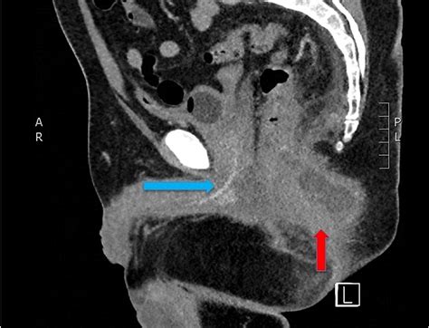 Cureus | Occult Perirectal Abscess Causing Acute Urinary Retention