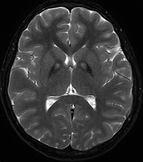 MRI Brain Scans Detect People with Early Parkinson's - Neuroscience News