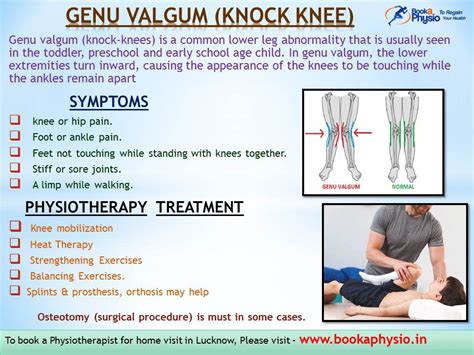 Genu Varum Exercises