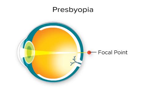 Types of Vision Problems & Treatments - IRIS Ophthalmology Clinic