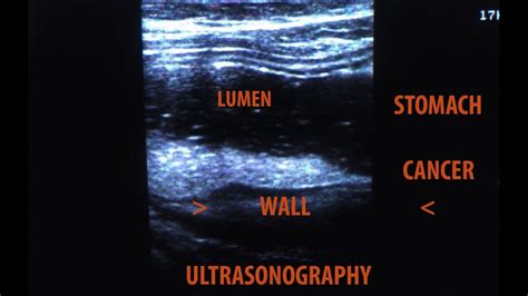 # GASTRIC ULTRASOUND # I STOMACH CANCER I - YouTube