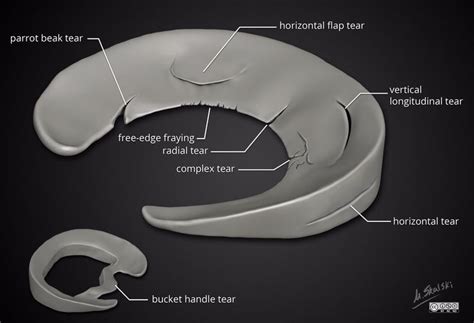 Meniscal tear types. Illustration by Dr. Matt Skalski (Twitter @docskalski) | Radiology ...