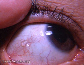 bulbar conjunctival lymph cyst. EyeRounds.org: Online Ophthalmic Atlas