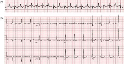 Supraventricular Tachycardia Ecg Features | Images and Photos finder