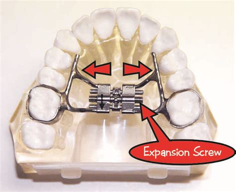 What is a Rapid Palatal Expander? | Your Smiling Faces.com