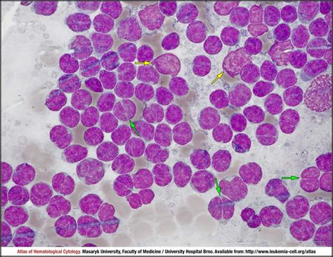 Follicular lymphoma - CELL - Atlas of Haematological Cytology