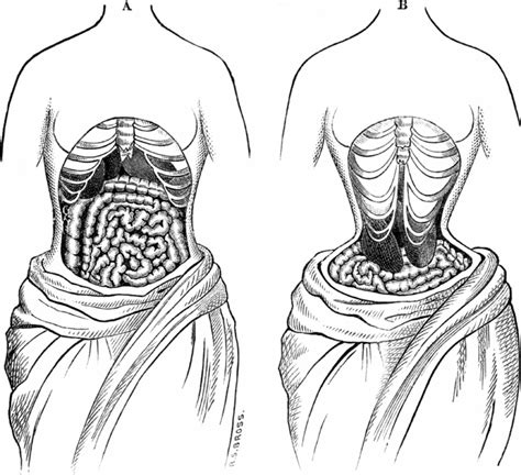 The Horrifying Legacy of the Victorian Tapeworm Diet - Gastro Obscura