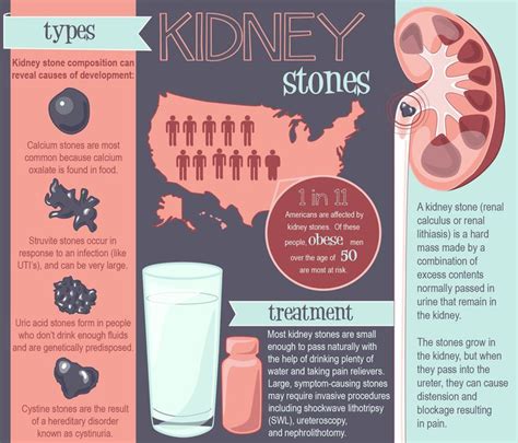 Types of Kidney Stones | Kidney stones, Preventing kidney stones, Kidney