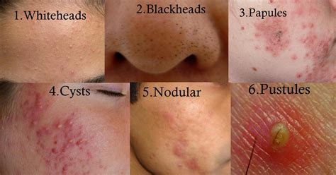 [Acne] This might be a stupid question, but can I be genetically prone to have more acne on my ...