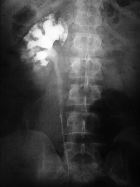 Medullary sponge kidney on IVP | Radiology Case | Radiopaedia.org | Medullary sponge kidney ...