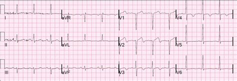 Dr. Smith's ECG Blog: Reversible T-wave inversion -- it reverses, then evolves, then reverses ...