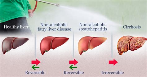 Treatment of Non-Alcoholic Fatty Liver Disease (NAFLD) - Fatty Liver Remedy