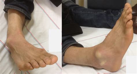 Subtalar dislocation | The Foot and Ankle Online Journal