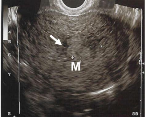 Transverse intravaginal ultrasound image of uterine cor | Open-i