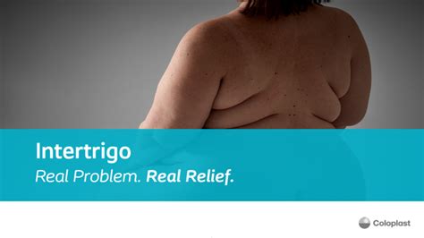 Intertrigo: Real Problem, Real Relief | WoundSource