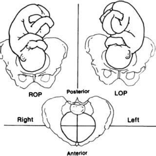 Fetal occipito-posterior (OP) position*. There are three OP positions:... | Download Scientific ...