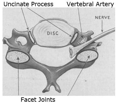 Whiplash Injury and the Uncinate Process