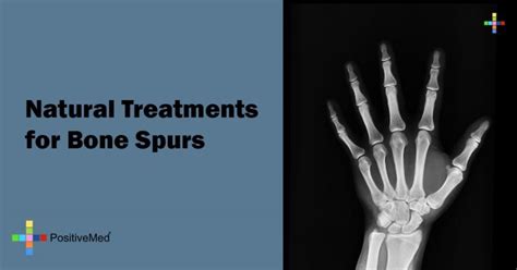 natural treatments for bone spurs