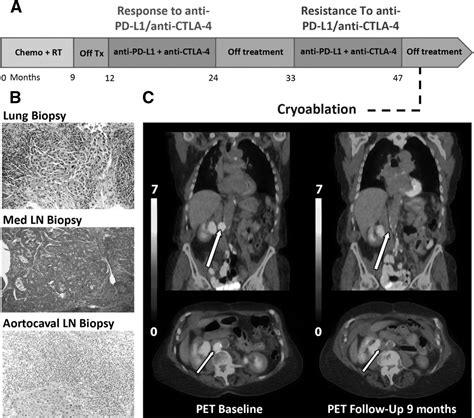 Cryotherapy for nodal metastasis in NSCLC with acquired resistance to immunotherapy | Journal ...