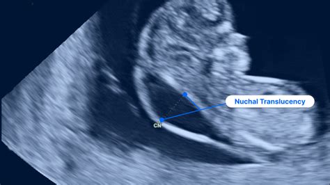 13-Week Ultrasound: Pictures, Gender Prediction and Baby's Growth