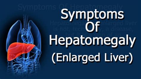 Symptoms Of Hepatomegaly (Enlarged Liver) - YouTube