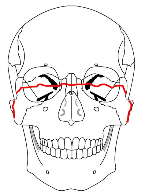 Le Fort facial fractures • LITFL Medical Blog • Medical Eponym Library