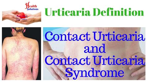 Urticaria Definition - Contact Urticaria and Contact Urticaria Syndrome - YouTube